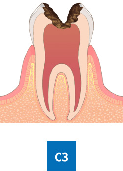 神経に達した虫歯